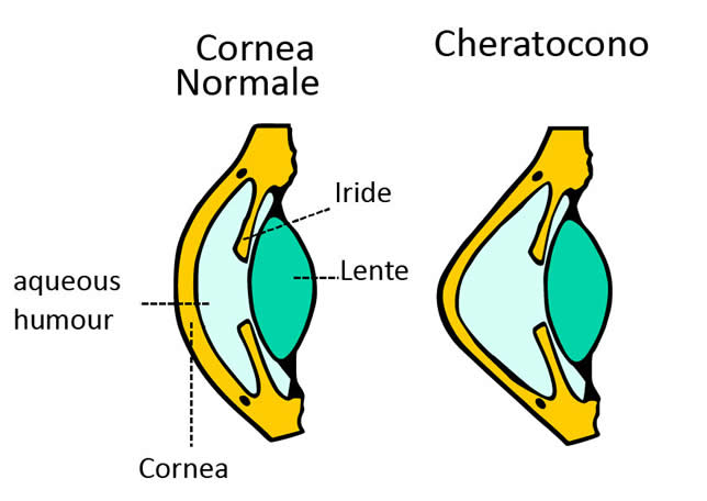 Astigmatismo O Cheratocono Fondamentale Una Diagnosi Precoce 